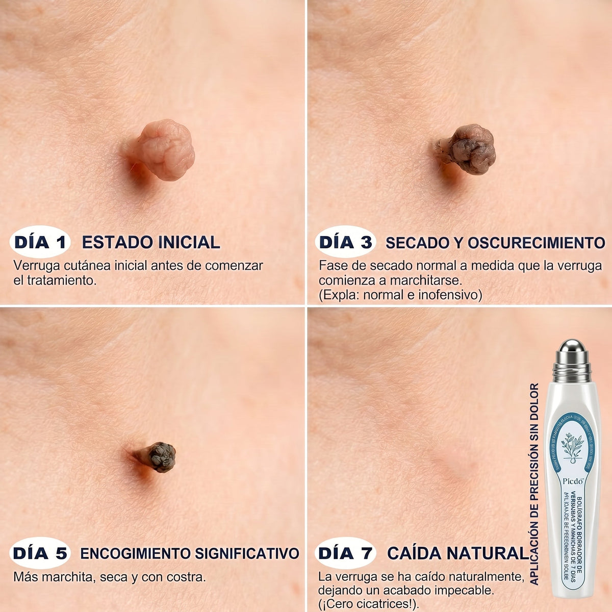 𝐏𝐢𝐜𝐝𝐨®🌸🌸 Borrador de Verrugas y Manchas en 7 Días (𝐀𝐩𝐥𝐢𝐜𝐚𝐝𝐨𝐫 𝐫𝐨𝐥𝐥-𝐨𝐧: 𝐬𝐢𝐧 𝐝𝐨𝐥𝐨𝐫 𝐧𝐢 𝐜𝐢𝐜𝐚𝐭𝐫𝐢𝐜𝐞𝐬)✨