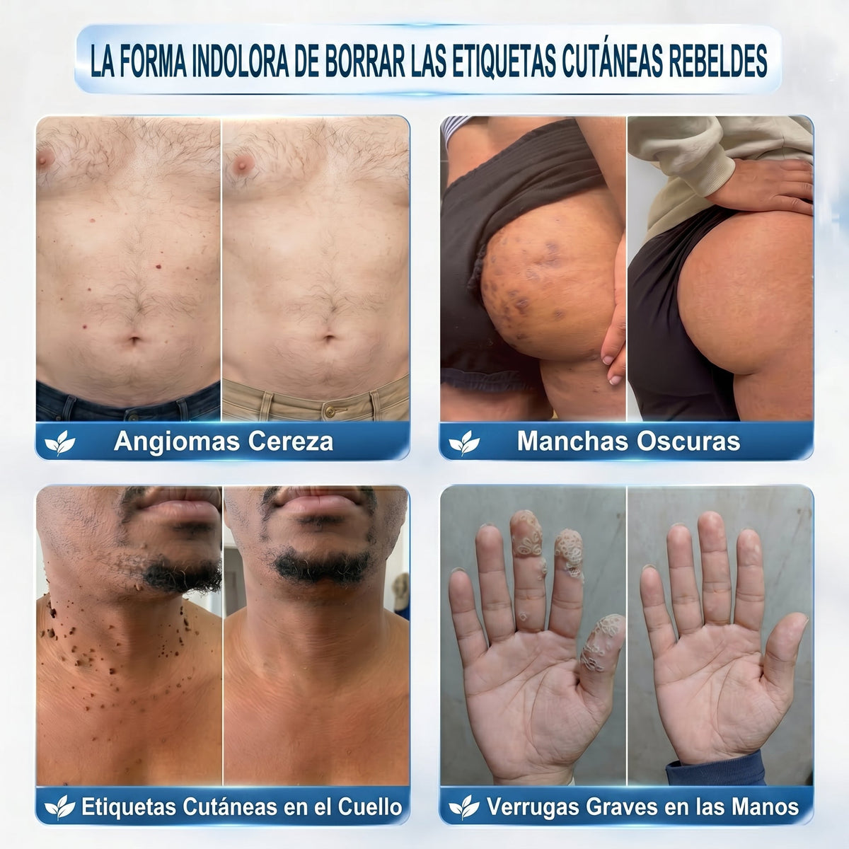 𝐏𝐢𝐜𝐝𝐨®🌸🌸 Borrador de Verrugas y Manchas en 7 Días (𝐀𝐩𝐥𝐢𝐜𝐚𝐝𝐨𝐫 𝐫𝐨𝐥𝐥-𝐨𝐧: 𝐬𝐢𝐧 𝐝𝐨𝐥𝐨𝐫 𝐧𝐢 𝐜𝐢𝐜𝐚𝐭𝐫𝐢𝐜𝐞𝐬)✨
