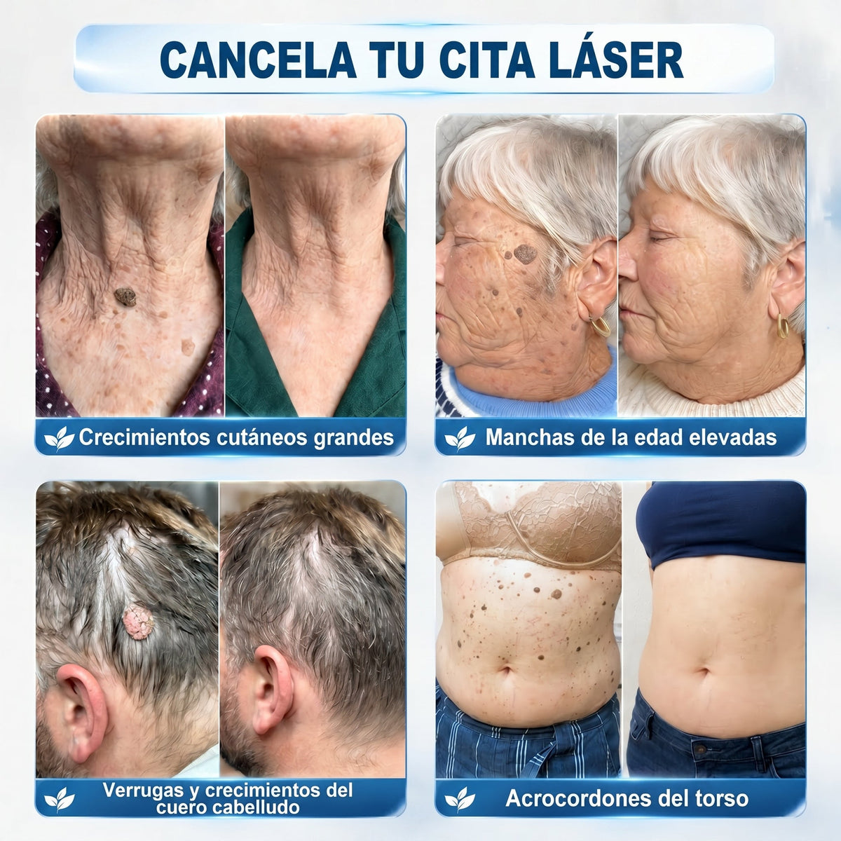 𝐏𝐢𝐜𝐝𝐨®🌸🌸 Borrador de Verrugas y Manchas en 7 Días (𝐀𝐩𝐥𝐢𝐜𝐚𝐝𝐨𝐫 𝐫𝐨𝐥𝐥-𝐨𝐧: 𝐬𝐢𝐧 𝐝𝐨𝐥𝐨𝐫 𝐧𝐢 𝐜𝐢𝐜𝐚𝐭𝐫𝐢𝐜𝐞𝐬)✨